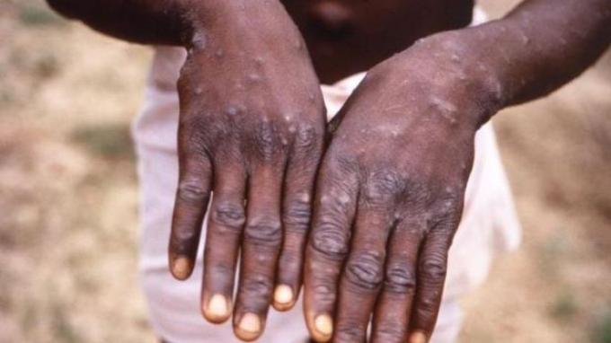 PAFI MAGETAN : Fakta Virus Monkeypox Jenis Baru, Menyebar ke Negara Mana, Gejala hingga Cara Melindungi Diri